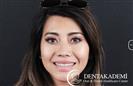 Laminate Veneer - DENTAKADEMI Oral and Dental Healthcare Center