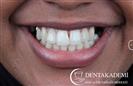 Root Canal Treatment, Laminate Veneers - DENTAKADEMI Oral and Dental Healthcare Center
