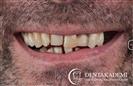 Tooth Extraction and Dental Implants: All-on-6 Implants & All-on-4 Implants - DENTAKADEMI Oral and Dental Healthcare Center