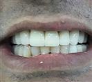 Porcelain Veneers - Uzmanlar Oral and Dental Health Clinic