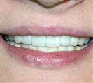Prosthetic Dentistry - Uzmanlar Oral and Dental Health Clinic