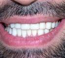 Dental Cleaning - Uzmanlar Oral and Dental Health Clinic