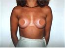 Breast  Augmentation Surgery - Optimed Hospital