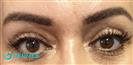 Botox (Lower Eyelid + Forehead) - Hermes Clinics