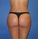 Brazilian Butt Lift - Hermes Clinics