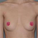 Breast Augmentation - Hermes Clinics