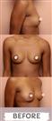 Breast Augmentation - Hermes Clinics