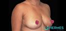 Breast Lift - Hermes Clinics