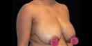 Breast Lift - Hermes Clinics