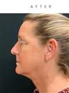 Chin Reduction Surgery - Hermes Clinics