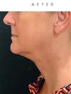 Chin Reduction Surgery - Hermes Clinics