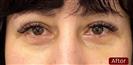 Upper and Lower Eyelid Surgery (Upper and Lower Blepharoplasty) - Hermes Clinics
