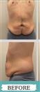 Abdominal Liposuction - Hermes Clinics