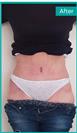 Abdominoplasty - Can Healthcare Group