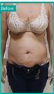Abdominoplasty - Can Healthcare Group