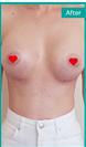 Breast Enlargement - Can Healthcare Group