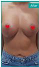 Breast Enlargement & Mastopexy - Can Healthcare Group