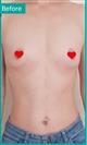 Breast Enlargement - Can Healthcare Group