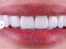 Laser Teeth Whitening - Can Healthcare Group