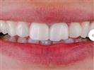 Laser Teeth Whitening - Can Healthcare Group