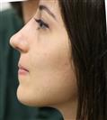 Rhinoplasty - Can Healthcare Group