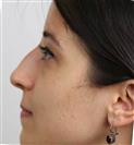 Rhinoplasty - Can Healthcare Group
