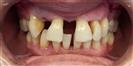 Dental Implants - West Dental Clinic