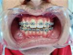Dental Braces - West Dental Clinic