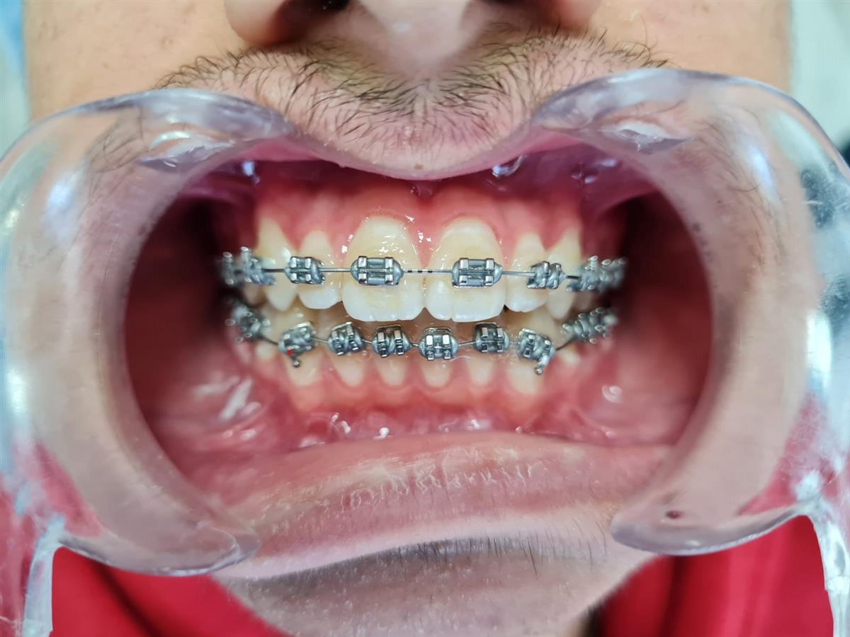 Dental Braces - West Dental Clinic