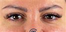 Eyelid Surgery - Cayra Clinic