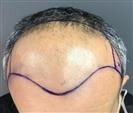 FUE Hair Transplant - Cayra Clinic