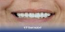 Porcelain Veneer - TrakyaDent Dental Health Center