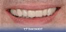 Porcelain Veneers - TrakyaDent Dental Health Center