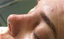 Rhinoplasty - The Nose Clinic International