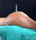Brazilian Butt Lift - Dr. Salih Onur Basat Clinic