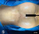 Brazilian Butt Lift - Dr. Salih Onur Basat Clinic