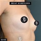 Breast Augmentation - Dr. Salih Onur Basat Clinic