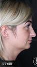 Double Chin - Vaser Liposuction - Ultrasonic Rhinoplasty - Dr. Salih Onur Basat Clinic