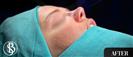 Rhinoplasty - Dr. Salih Onur Basat Clinic