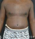 Tummy Tuck - Gynecomastia - Dr. Salih Onur Basat Clinic