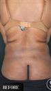 Tummy Tuck - Vaser Liposuction - J Plasma - Dr. Salih Onur Basat Clinic
