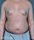 Tummy Tuck - Gynecomastia - Dr. Salih Onur Basat Clinic