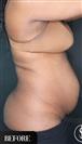 Tummy Tuck - Vaser Liposuction - J Plasma - Dr. Salih Onur Basat Clinic
