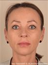 Zone treated: face, (cheekbones, jowls, nasolabial grooves, marionette lines) - Verdi Aesthetic Center