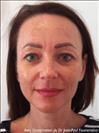Zone treated: face, (cheekbones, jowls, nasolabial grooves, marionette lines) - Verdi Aesthetic Center