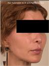 Zone treated: face, (cheekbones, jowls, nasolabial grooves, marionette lines) - Verdi Aesthetic Center