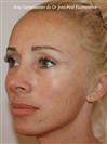 Zone treated: Face (cheekbones, jowls, nasolabial grooves, marionette lines) - Verdi Aesthetic Center