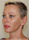 Zone treated: Face (cheekbones, jowls, nasolabial grooves, marionette lines) - Verdi Aesthetic Center