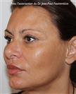 Zone treated: Face (cheekbones, jowls, nasolabial grooves, marionette lines) - Verdi Aesthetic Center