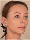 Zone treated: face, (cheekbones, jowls, nasolabial grooves, marionette lines) - Verdi Aesthetic Center